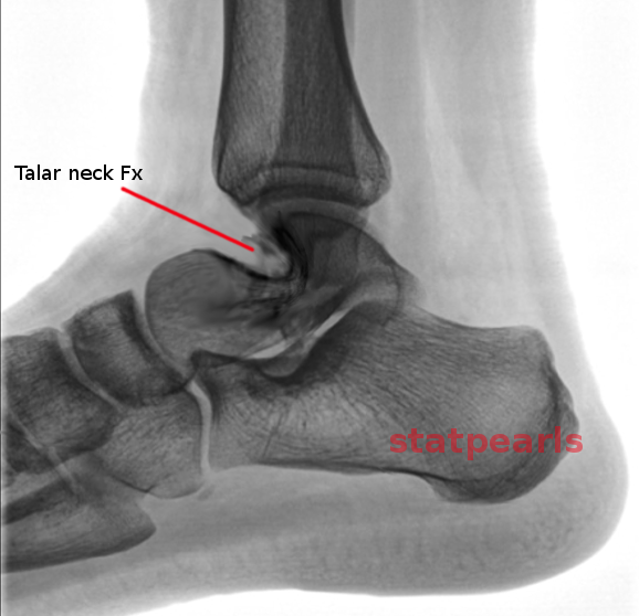 Talar neck fracture