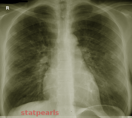 Non-cardiogenic pul edema