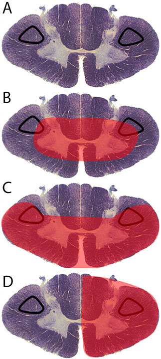 Corticospinal tract lesion locations
(A)	Normal spinal cord cross section