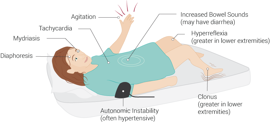 Serotonine Syndrome