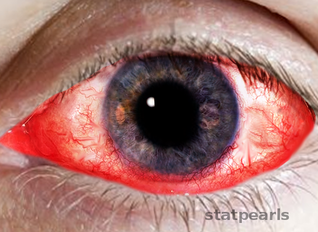 Keratoconjunctivitis