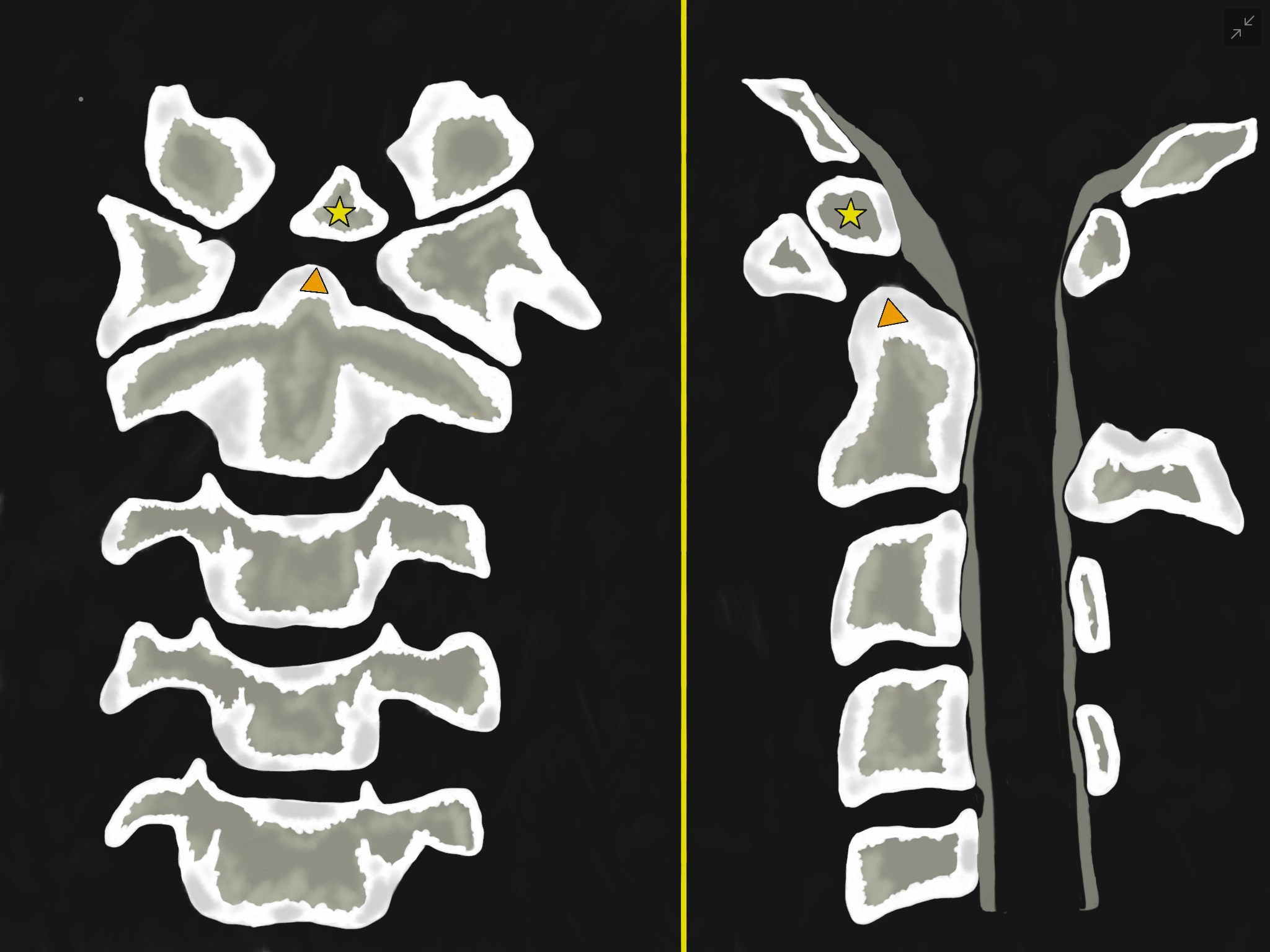 Figure 1 - Illustration that represents an upper cervical spine lateral view