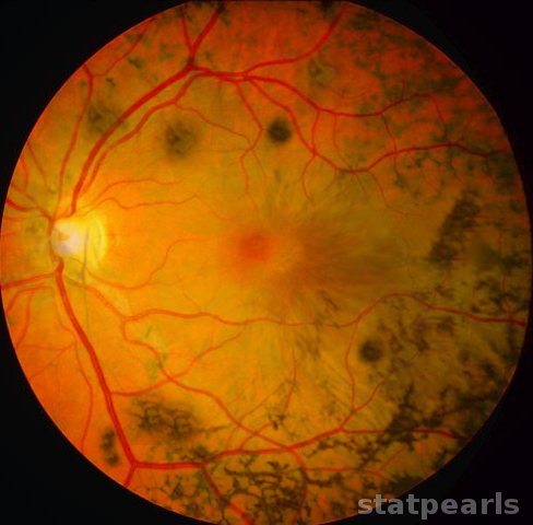 Retinitis pigmentosa