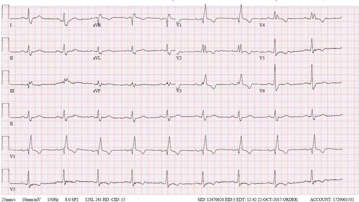 First degree Av block with Right Bundle Branch Block