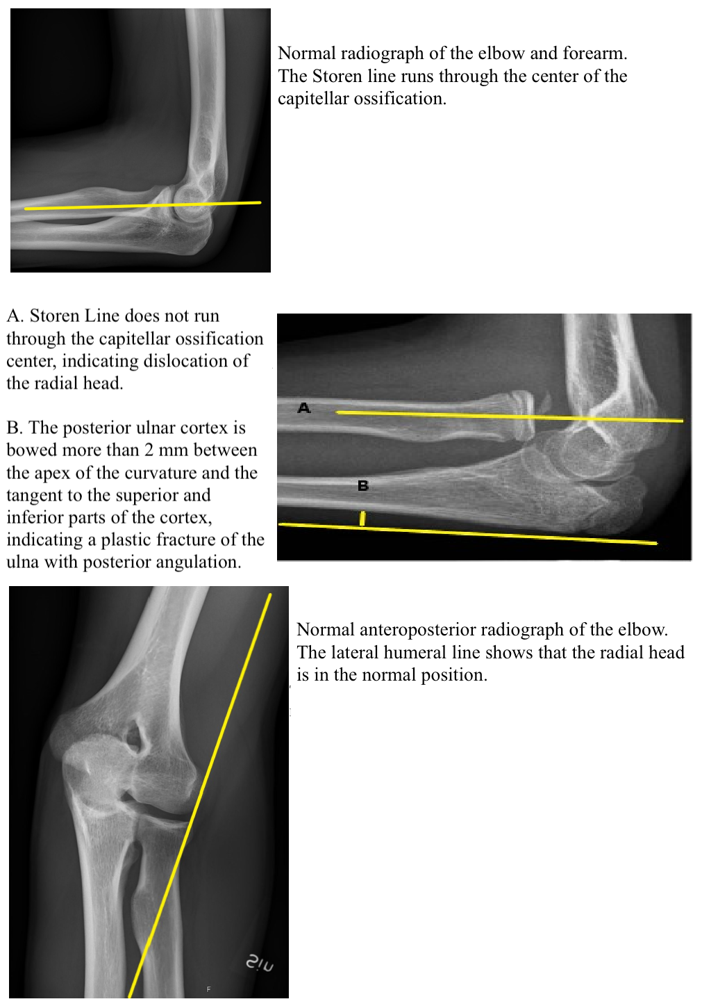 Radial Head Dislocation