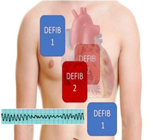 Double defibrillation