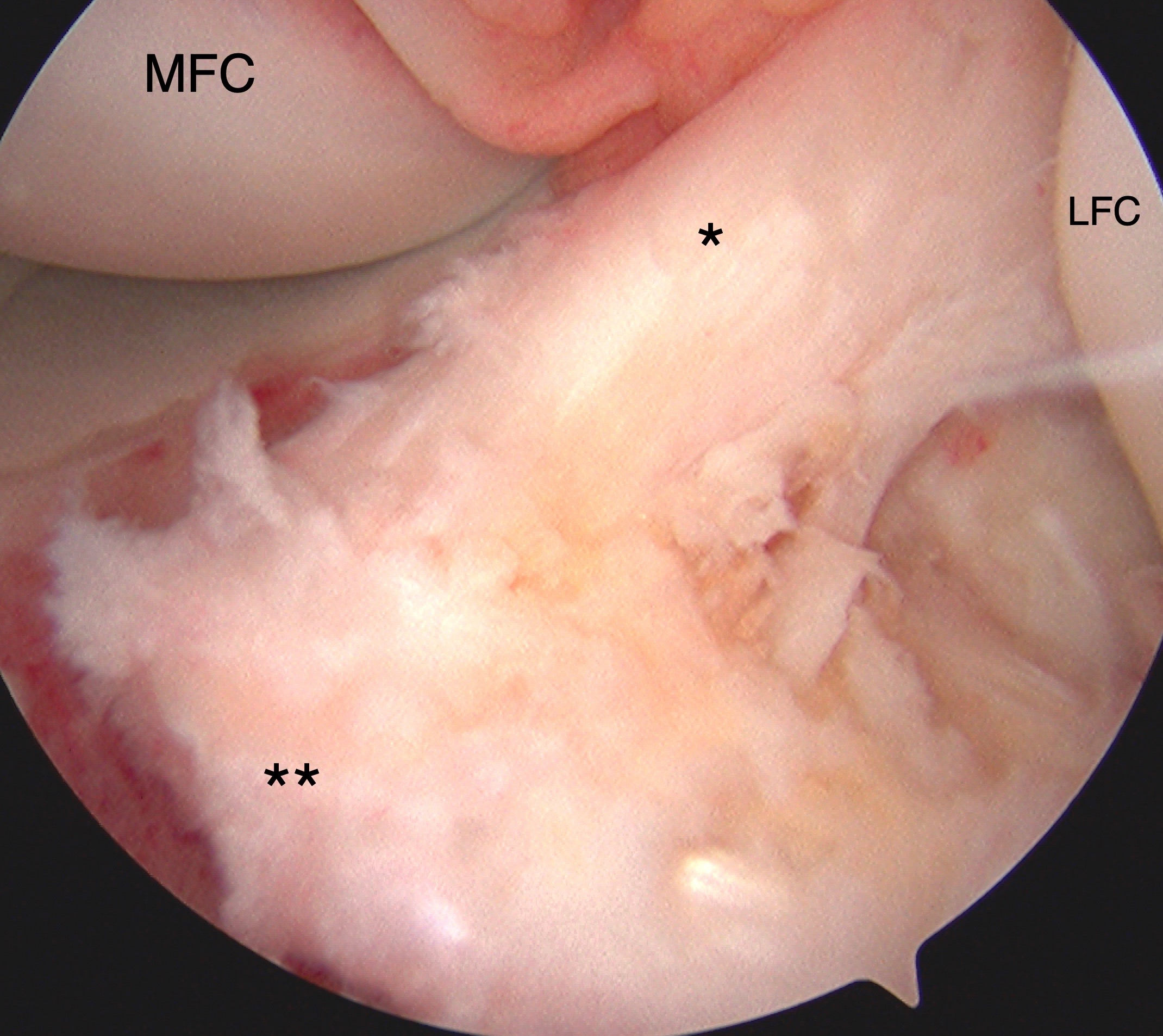 Tibial eminence avulsion injury confirmed with direct visualization during knee arthroscopy with arthroscopic-assisted internal fixation suture reduction technique