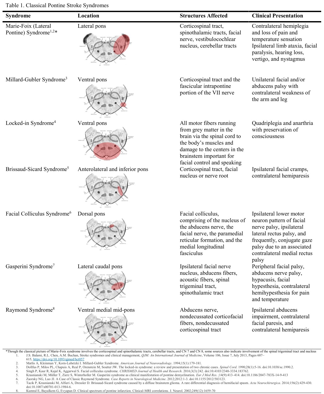 Classical Pontine Stroke Syndromes