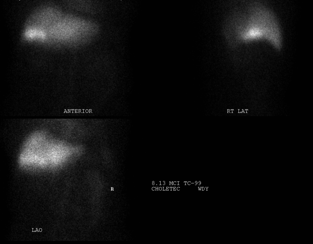 HIDA - nonvisualization of bowel