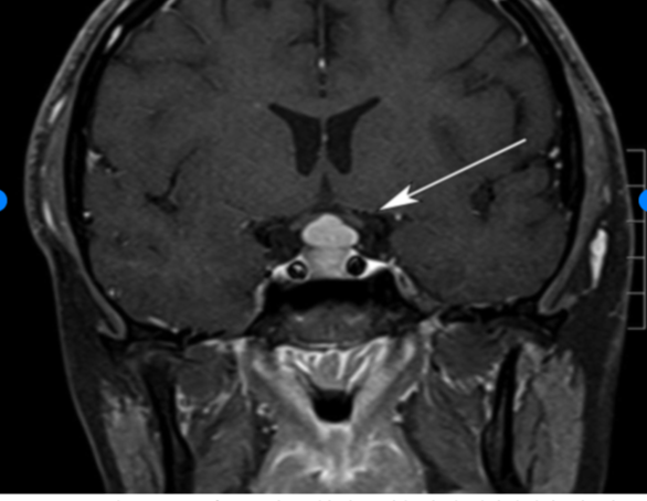 Tablets or scalpel: Pituitary hyperplasia due to primary hypothyroidism