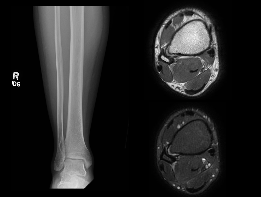 An AP radiograph of the tibia and fibula is shown which demonstrates an osseous lesion along the lateral aspect of the distal tibia with osseous remodeling of the adjacent fibula indicating a chronic indolent process