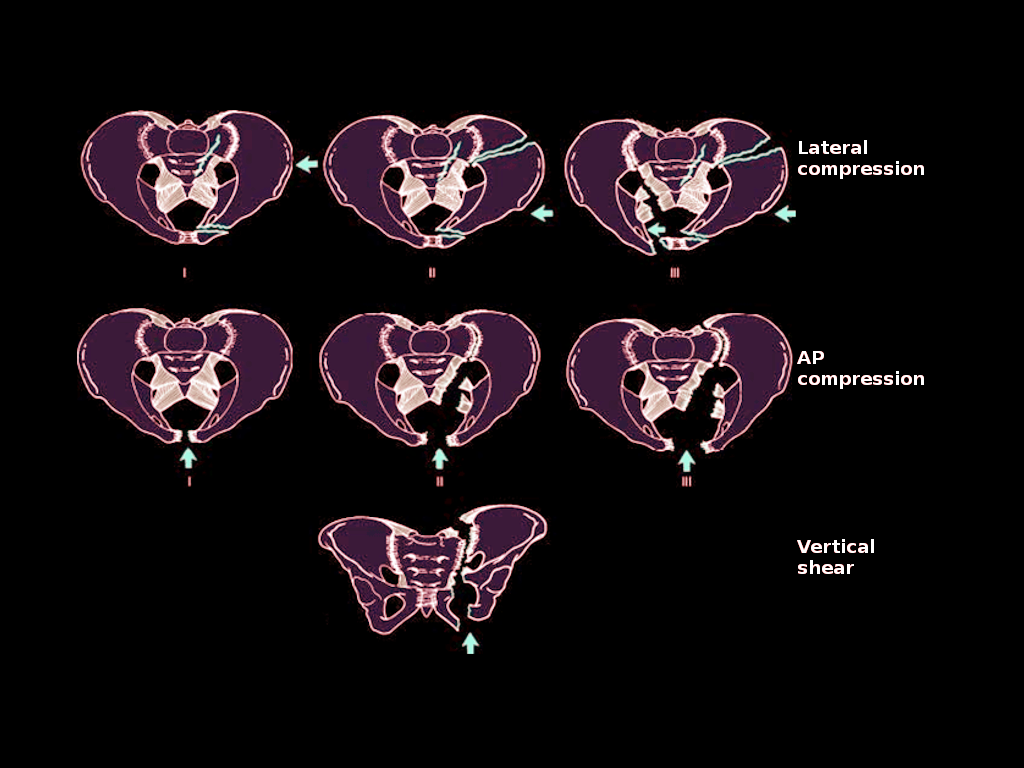 Pelvic ring injuries