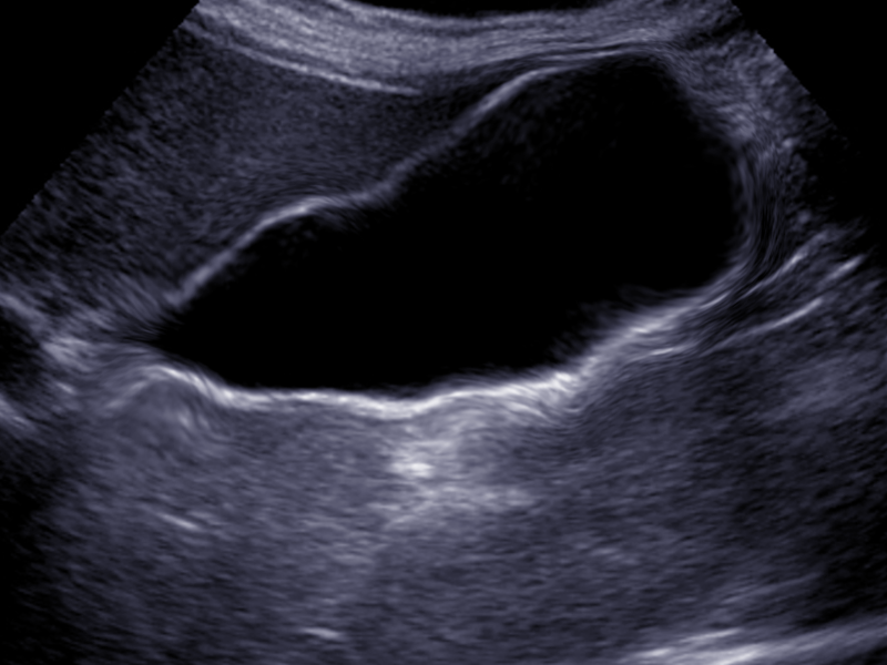 Acalculous cholecystitis