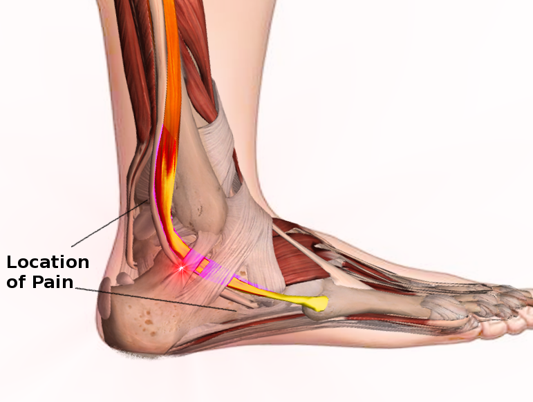 Peroneal tendon syndromes