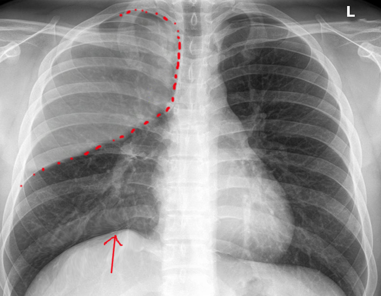 Post surgical atelectasis