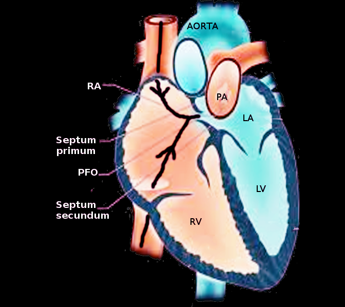 <p>Patent Foramen Ovale