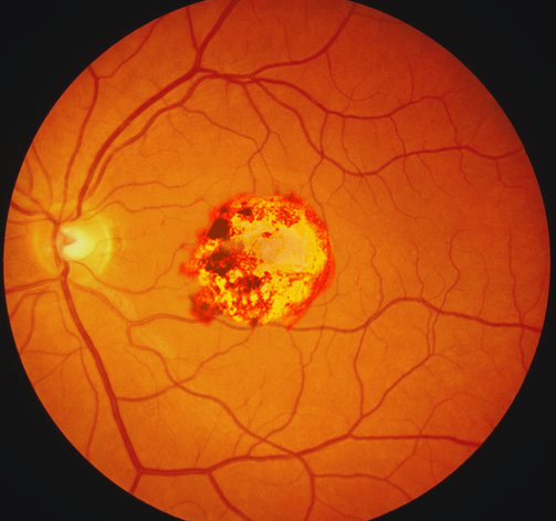 Congenital toxoplasmosis