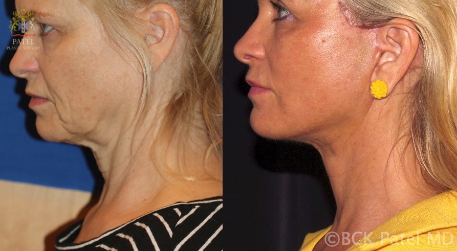 Result of a deep-plane facelift