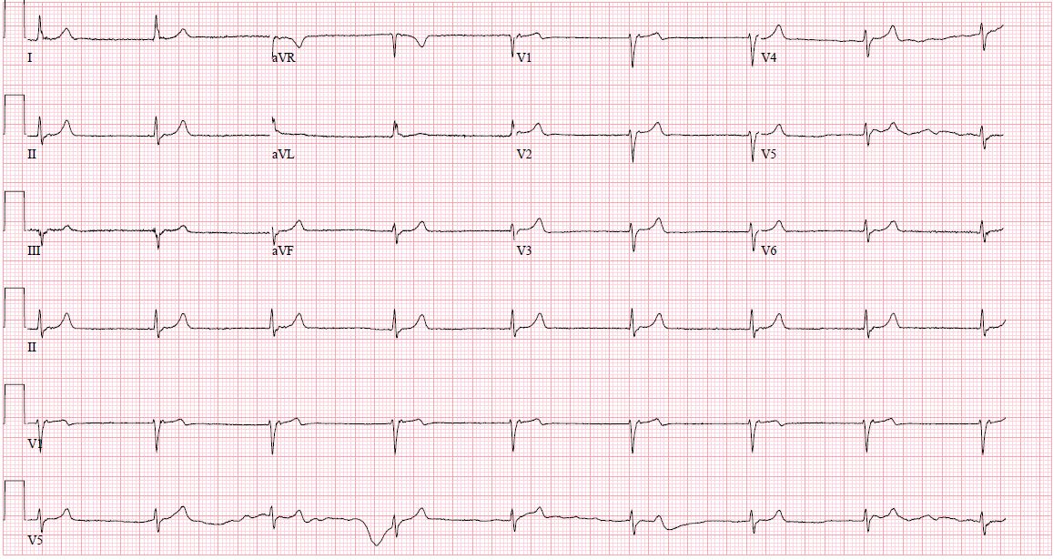 Junctional Rhythm