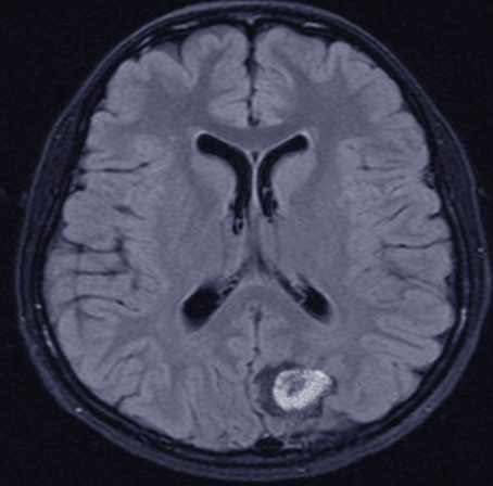 CNS lymphoma