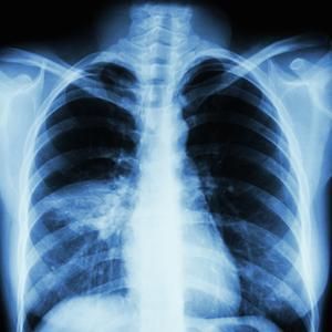 Ventilator associated pneumonia
Aspiration Pneumonia