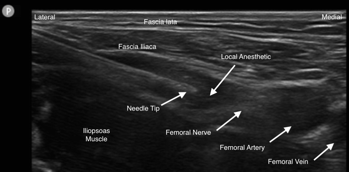 Femoral Nerve Block Image