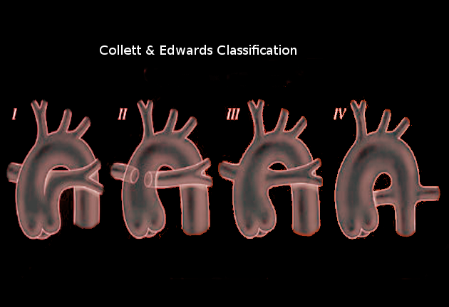 Truncus arteriosus