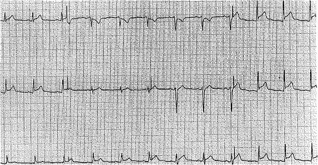 Acute pericarditis ECG