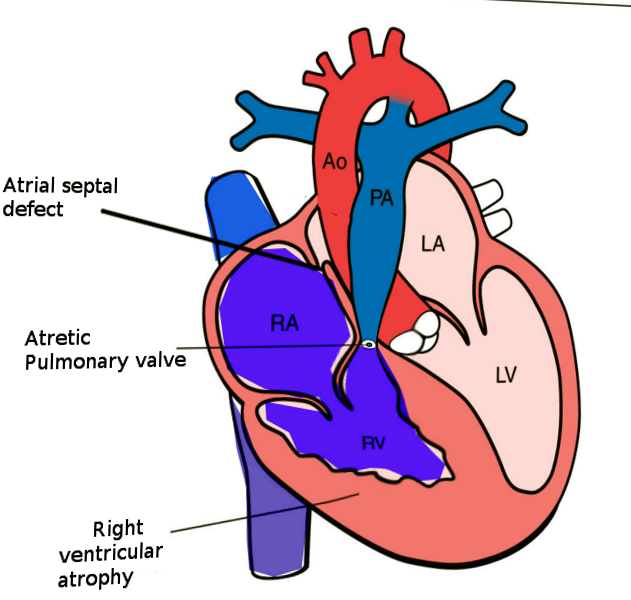 <p>Pulmonary Atresia With Intact Ventricular Septum