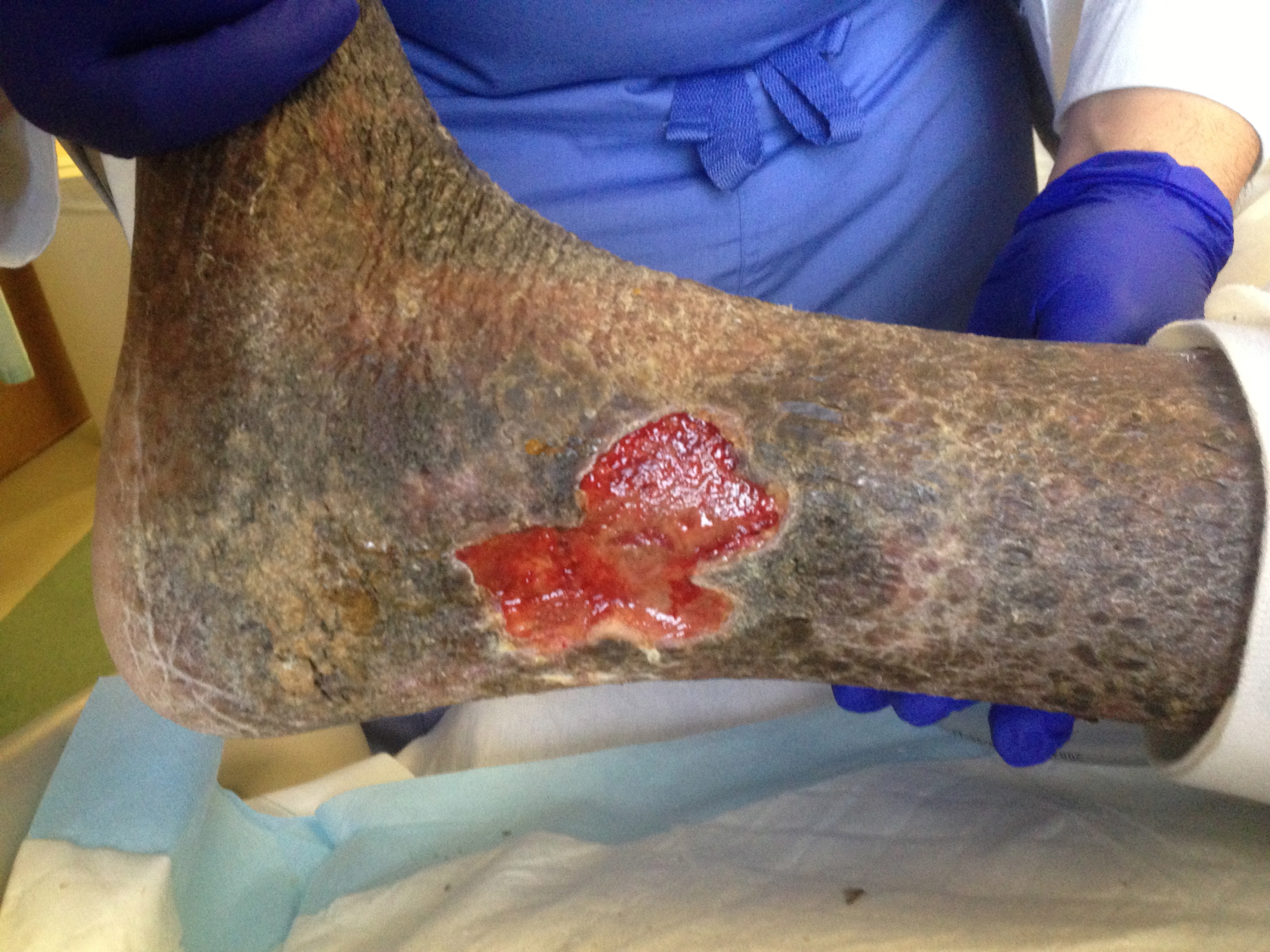 Chronic Lipodermatosclerosis and Venous Stasis Ulceration