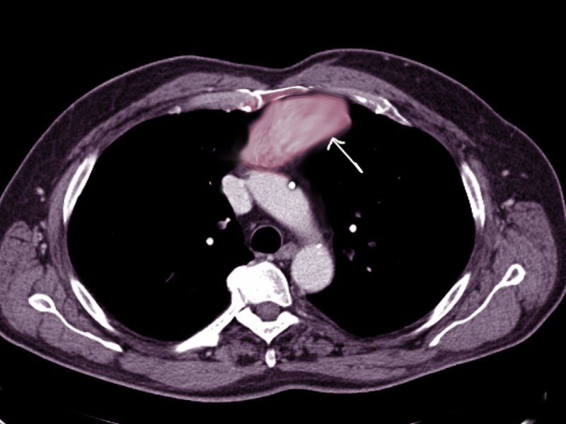 Anterior Mediastinal Mass