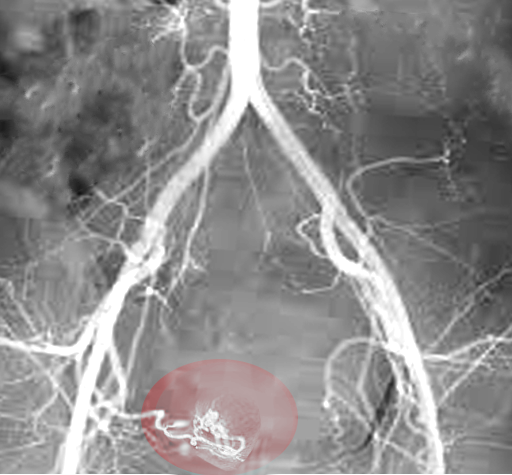 Uterine artery embolization