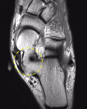 Talocalcaneal Coalition:
T1 MRI demonstrating middle facet subtalar joint osseous coalition on axial images.