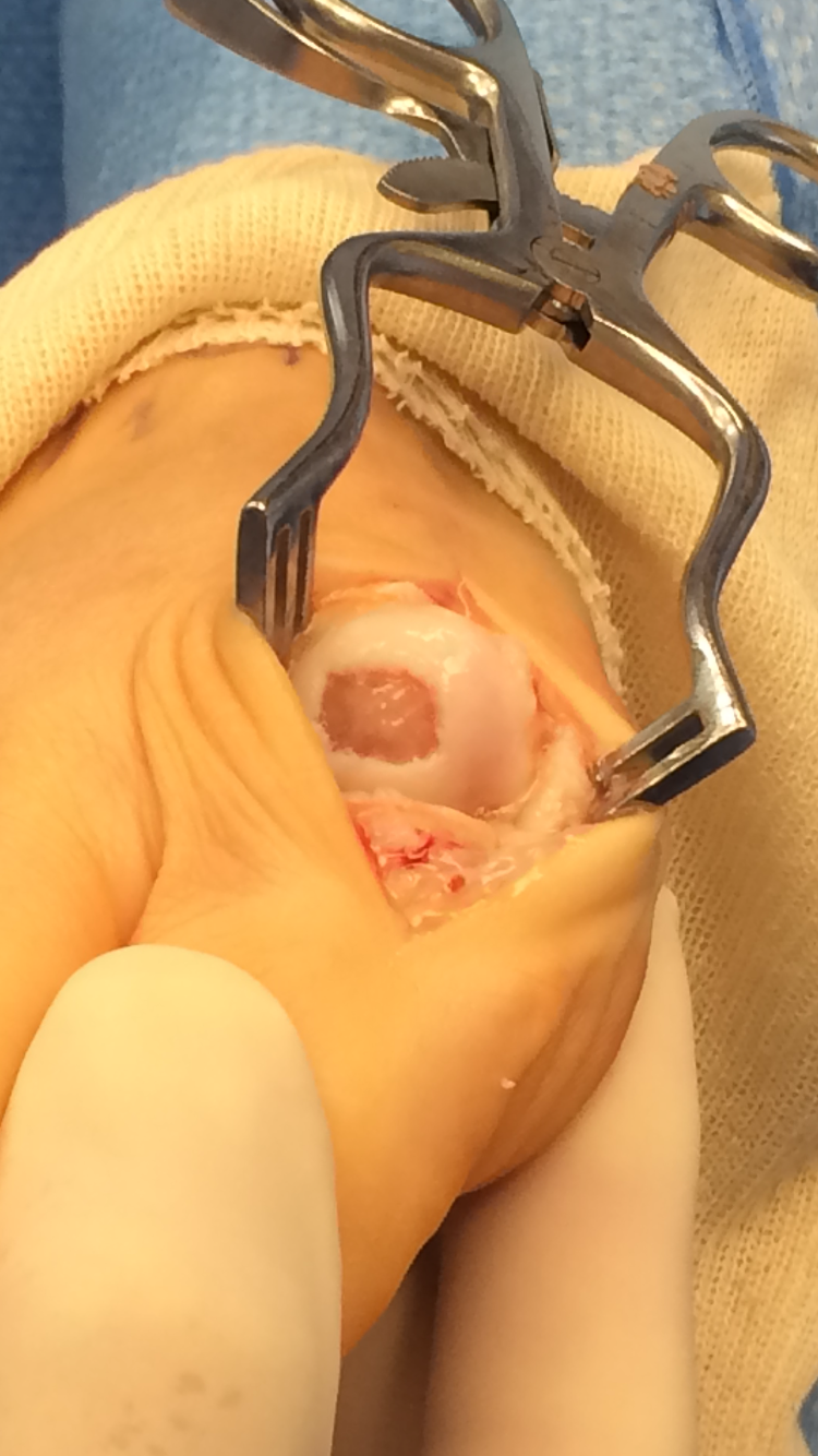 Osteochondritis Dissecans
Operative photograph demonstrating an osteochondral defect of the 1st metatarsal head secondary to acute trauma