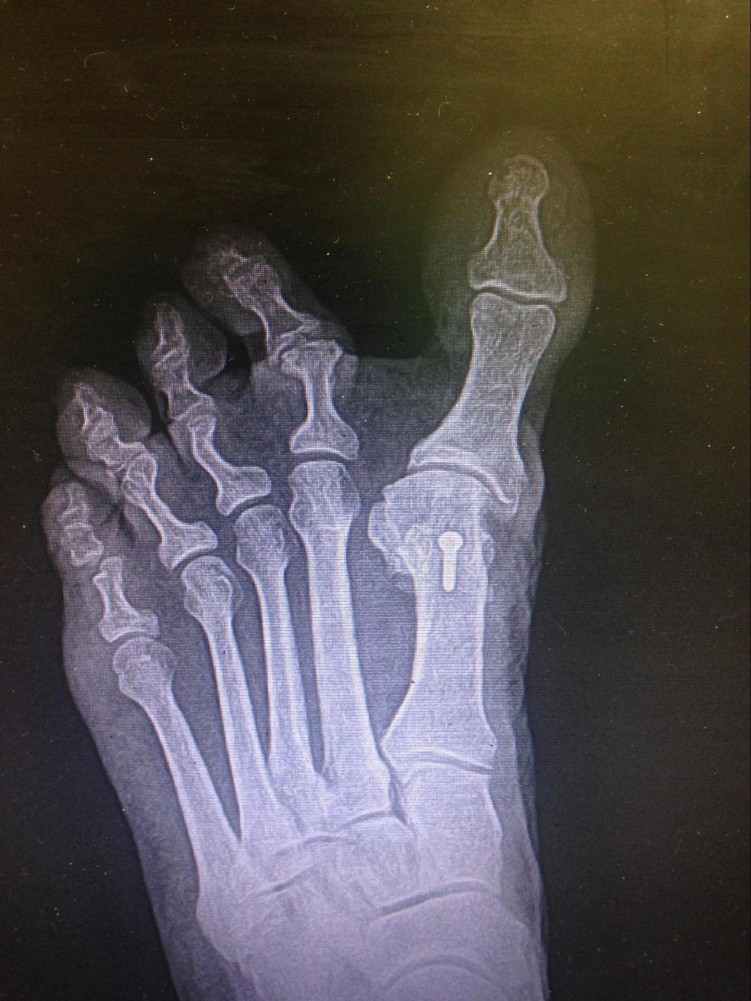 Hallux Varus
Iatrogenic Hallux varus or abduction in the transverse plane secondary to surgical overcorrection of hallux valgus (bunion)