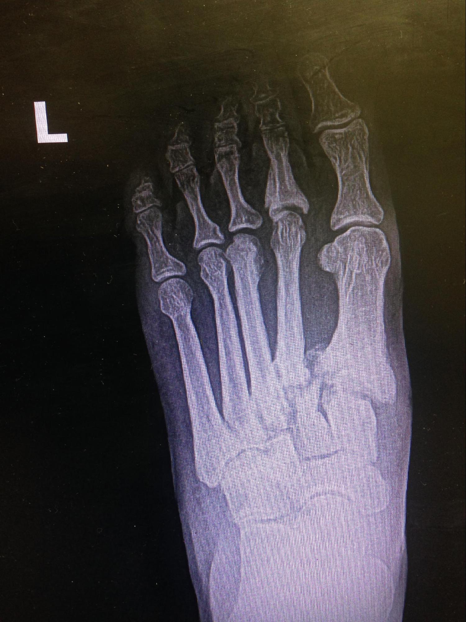 Lisfranc Dislocation
Tarsometatarsal fracture-dislocation