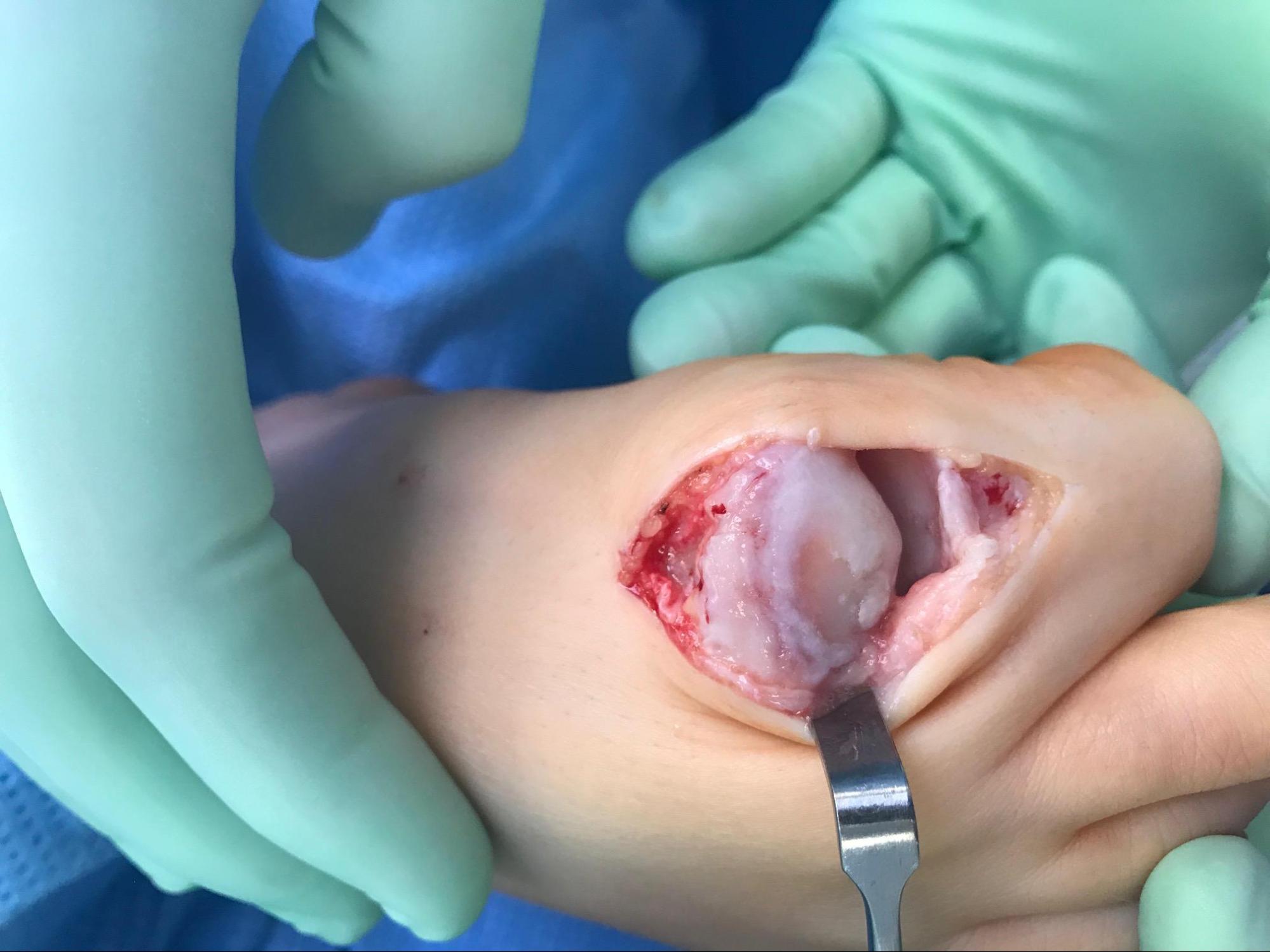 Osteoarthritis 
Operative photograph demonstrating osteoarthritis of the 1st metatarsal phalangeal joint