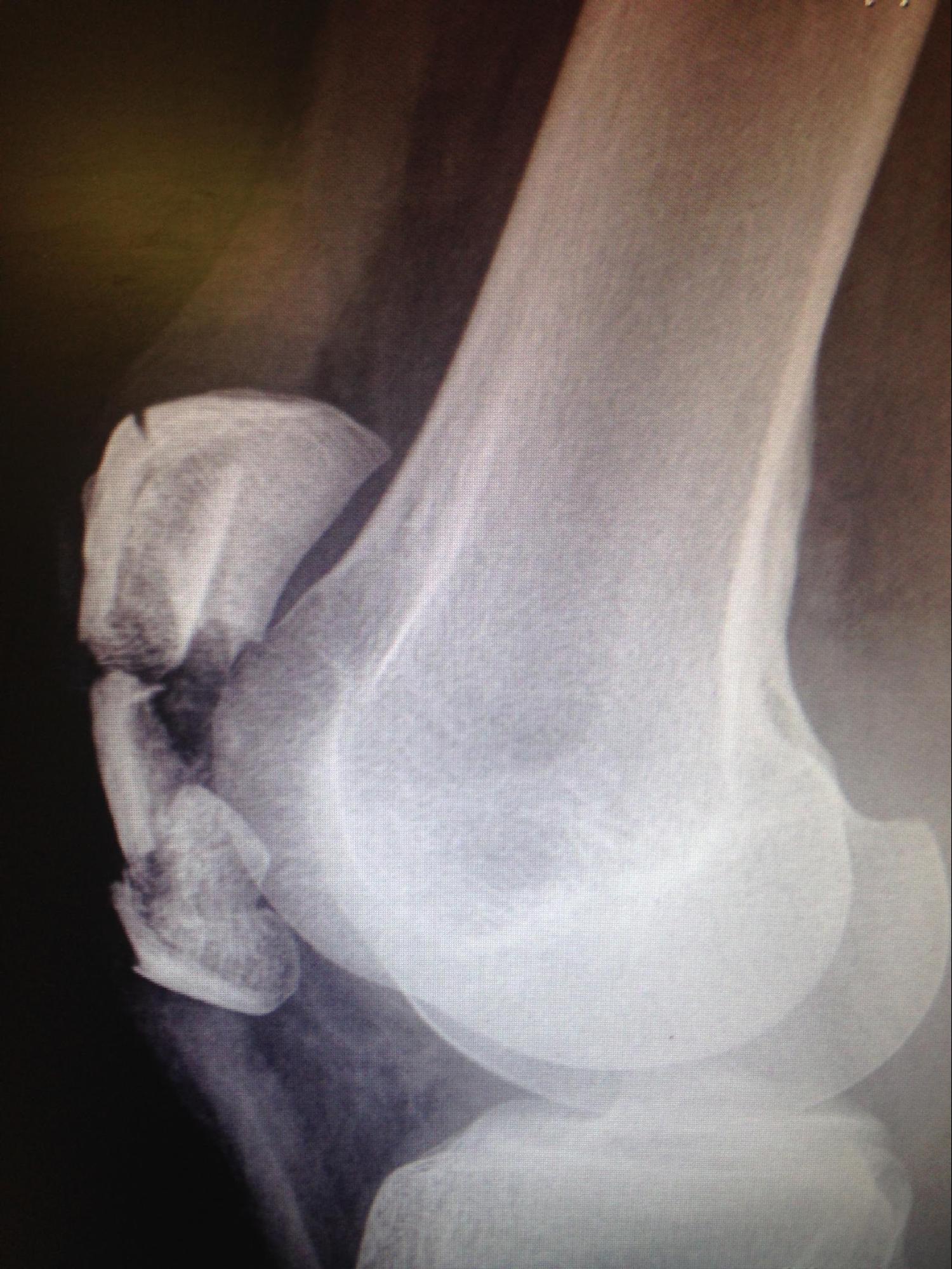 Patellar Fractures
Note the comminution and displacement.