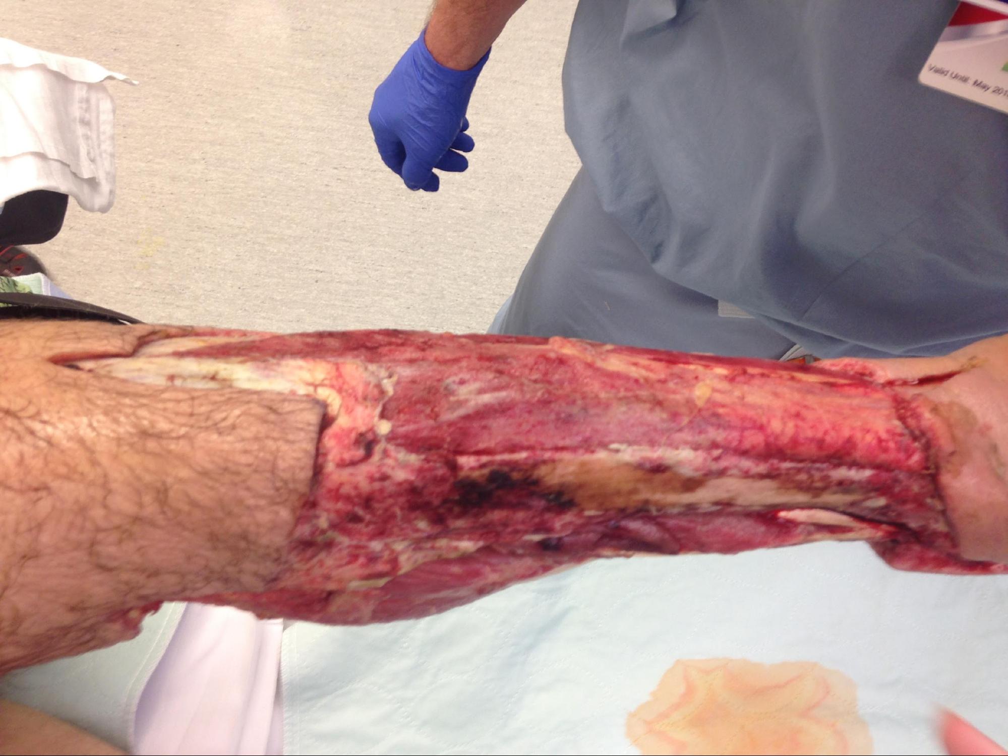 Necrotizing Fasciitis
Appearance of lower leg after serial debridements of skin and fascia.