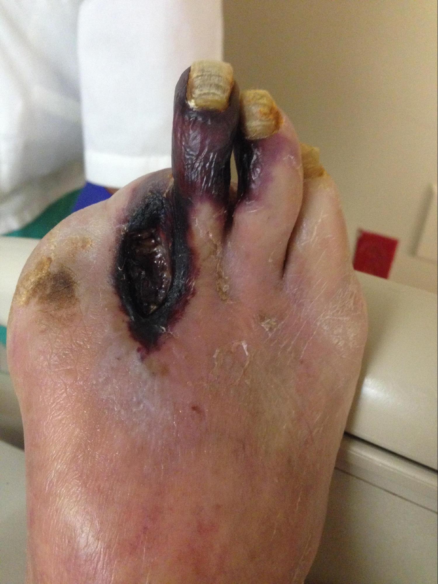 Peripheral Arterial Disease
Non-healing necrotic ulceration and gangrene of the 3rd digit secondary to PAD.