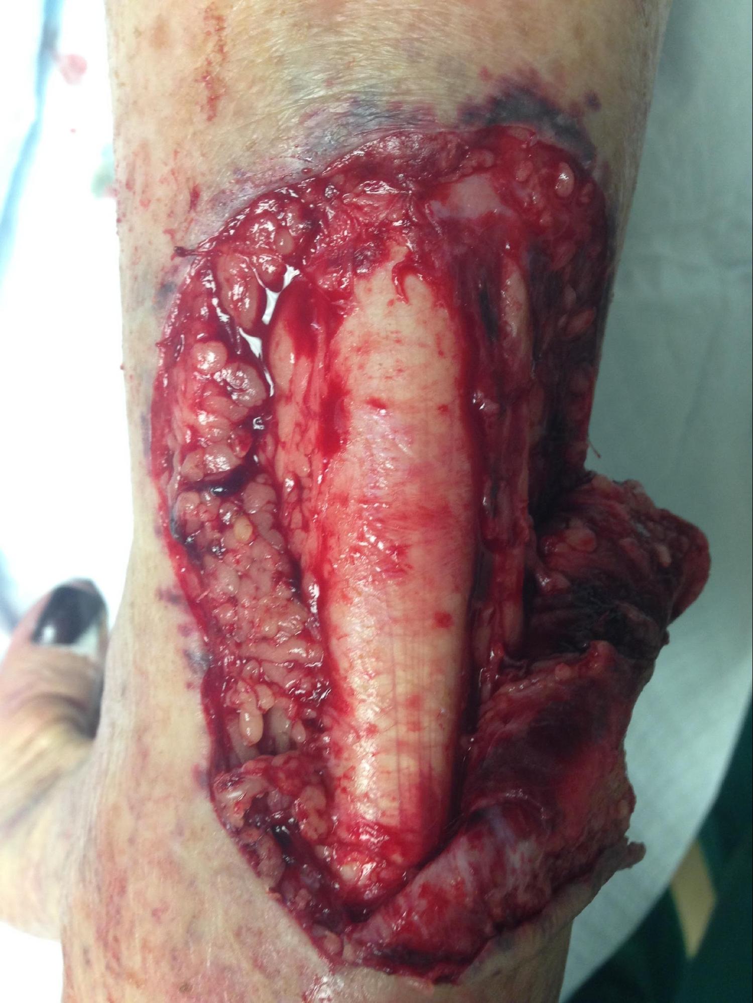 Laceration
Full-thickness skin laceration of the posterior ankle exposing the Achilles tendon.