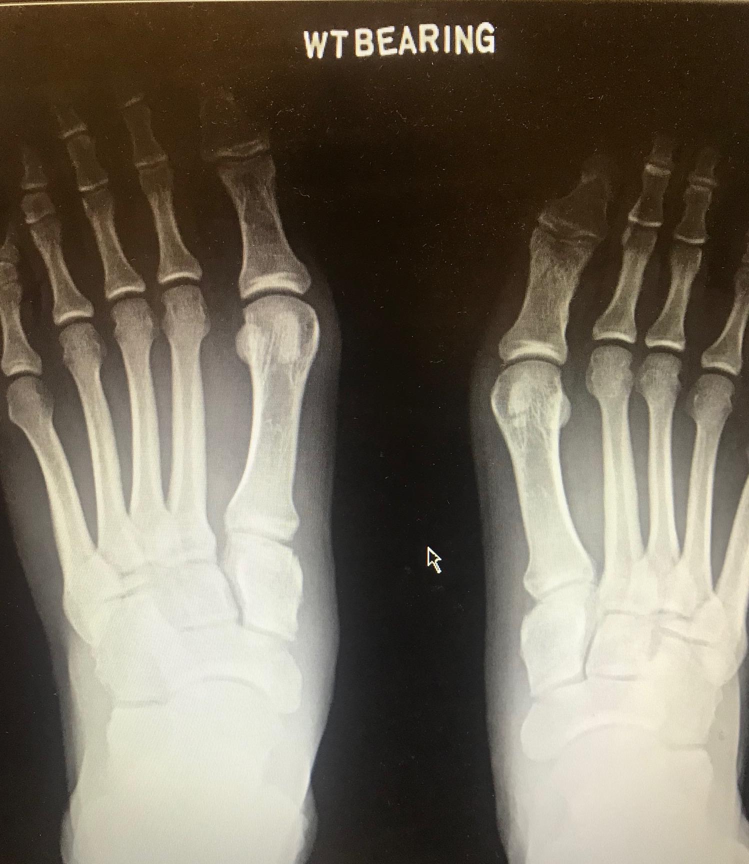 Lisfranc Dislocation
Bilateral weight bearing radiographs demonstrating a subtle diastasis on the left foot due to lisfranc ligament rupture