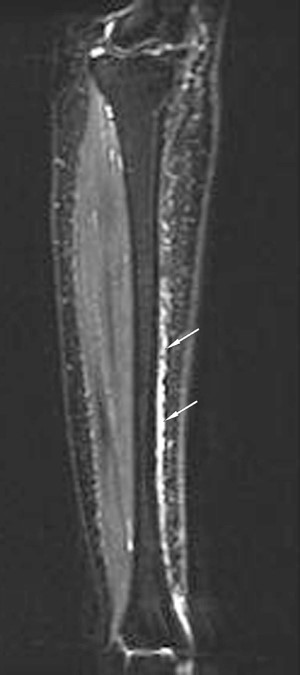 MRI image of a grade 1 stress fracture
Stress fracture lecture given by several US military sports medicine physicians