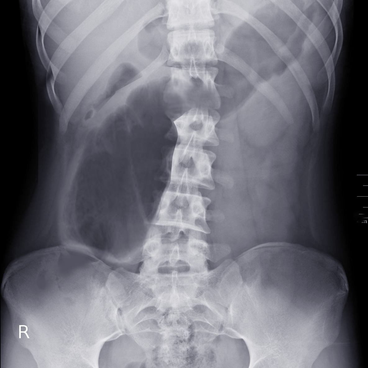 <p>Cecal Volvulus