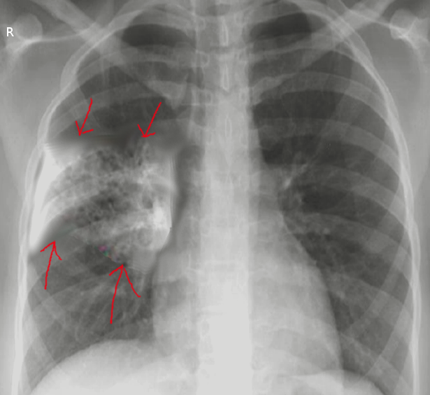 Aspiration pneumonia