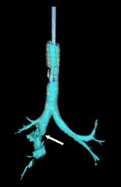 Tracheal injury