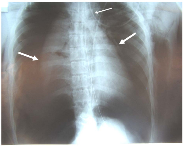 Bilateral pneumothoraces