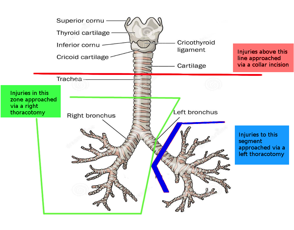 Incisions for tracheal surgery