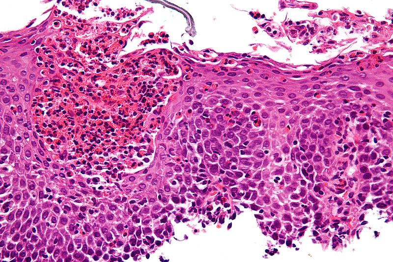 Eosinophilic gastroenteritis