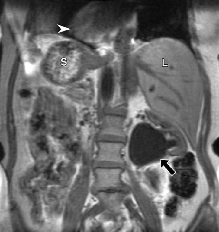 Situs inversus in a 56-year-old woman with left flank pain